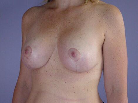 Breast Lift with Augmentation Before & After Image