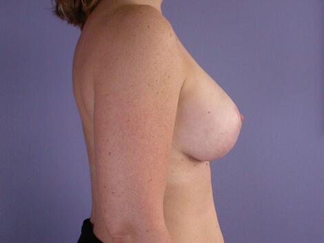 Breast Lift with Augmentation Before & After Image