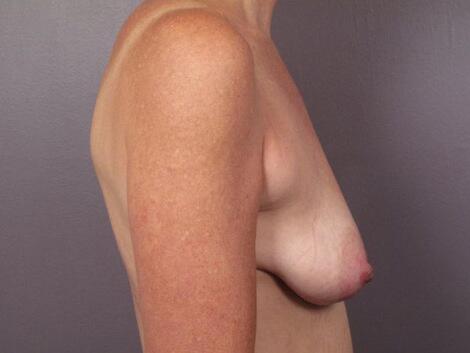 Breast Lift with Augmentation Before & After Image