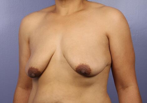 Breast Lift with Augmentation Before & After Image