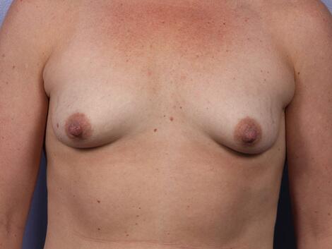 Breast Lift with Augmentation Before & After Image