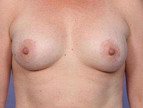 Breast Lift with Augmentation Before & After Image