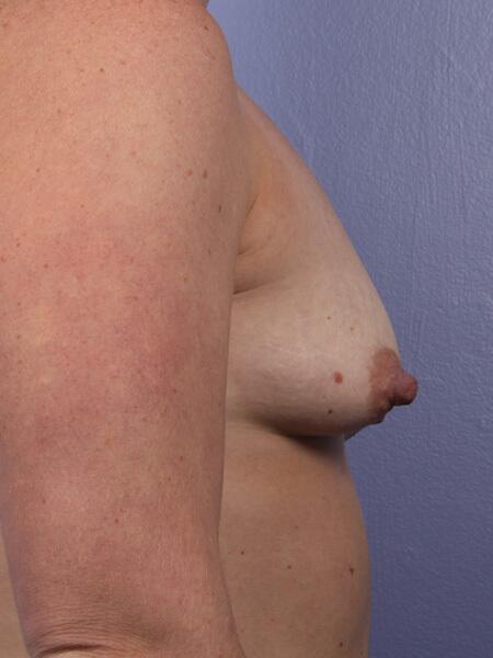 Breast Lift with Augmentation Before & After Image