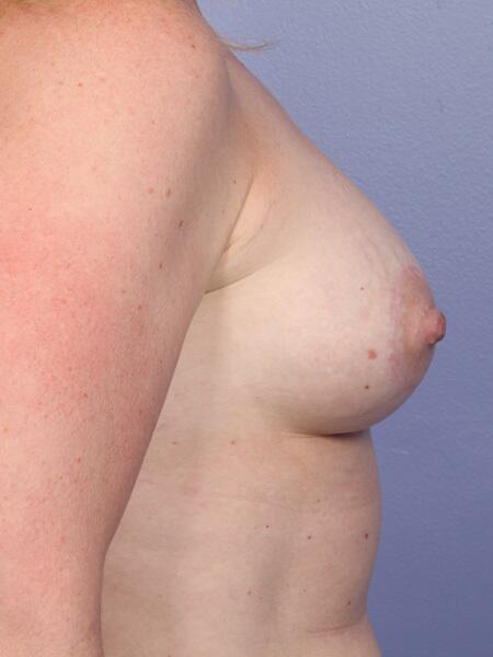 Breast Lift with Augmentation Before & After Image