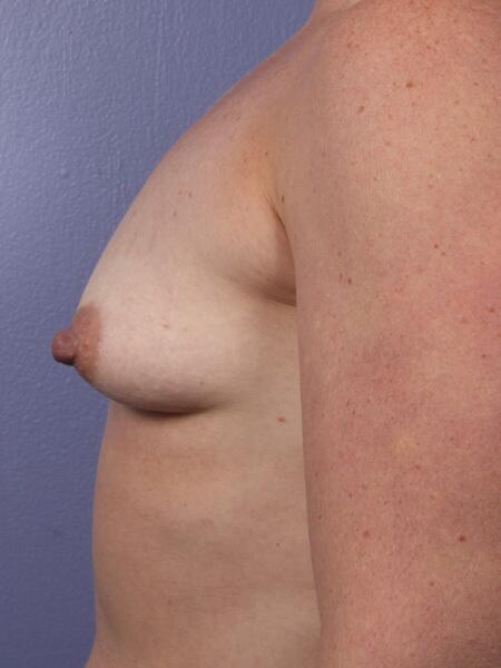 Breast Lift with Augmentation Before & After Image