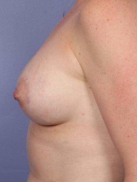 Breast Lift with Augmentation Before & After Image