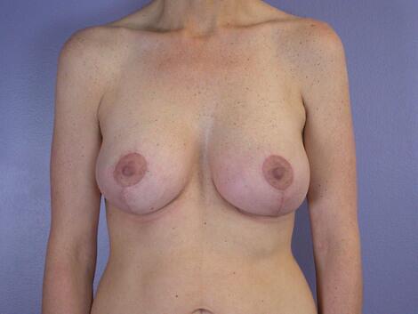 Breast Lift with Augmentation Before & After Image