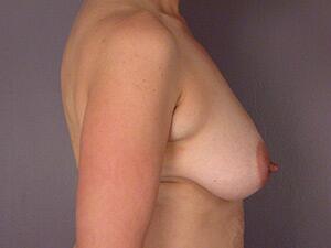 Breast Lift Before & After Image