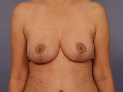 Breast Lift Before & After Image