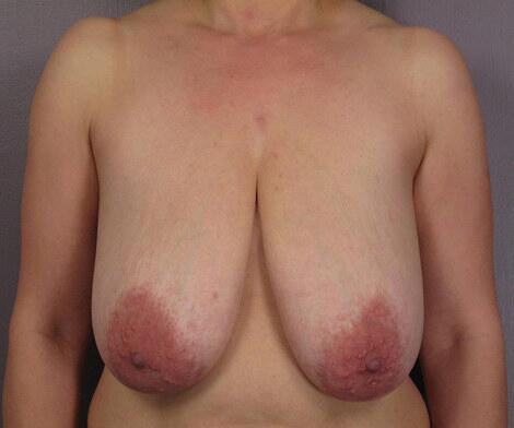 Breast Lift Before & After Image