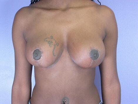 Breast Lift Before & After Image