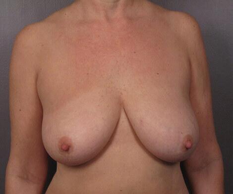 Breast Lift Before & After Image