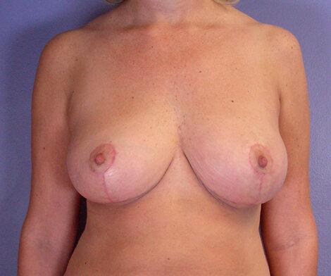 Breast Lift Before & After Image