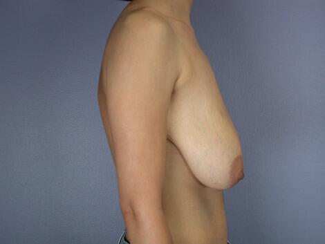 Breast Lift Before & After Image