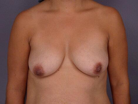 Breast Lift Before & After Image