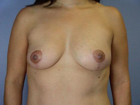 Breast Lift Before & After Image