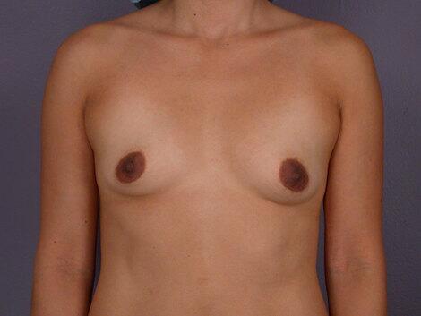 Breast Lift Before & After Image