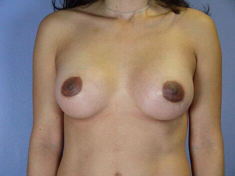 Breast Lift Before & After Image