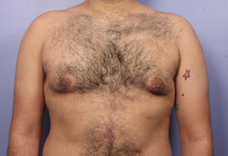 Breast Reduction (for Men) Before & After Image