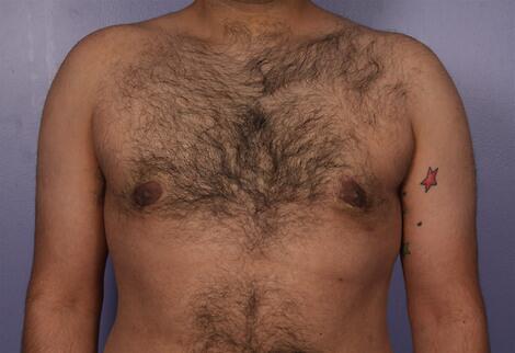 Breast Reduction (for Men) Before & After Image