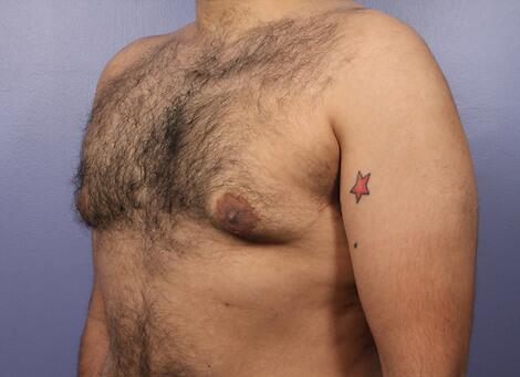 Breast Reduction (for Men) Before & After Image