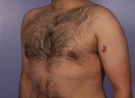 Breast Reduction (for Men) Before & After Image