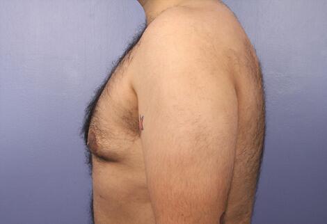 Breast Reduction (for Men) Before & After Image