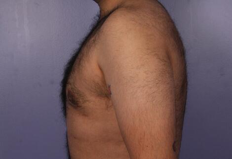 Breast Reduction (for Men) Before & After Image