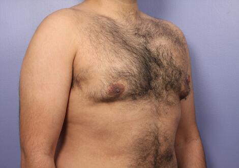 Breast Reduction (for Men) Before & After Image