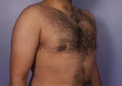 Breast Reduction (for Men) Before & After Image