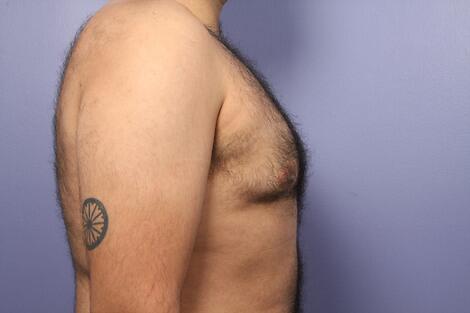 Breast Reduction (for Men) Before & After Image