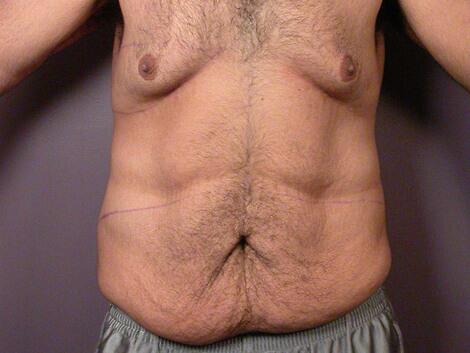 Breast Reduction (for Men) Before & After Image