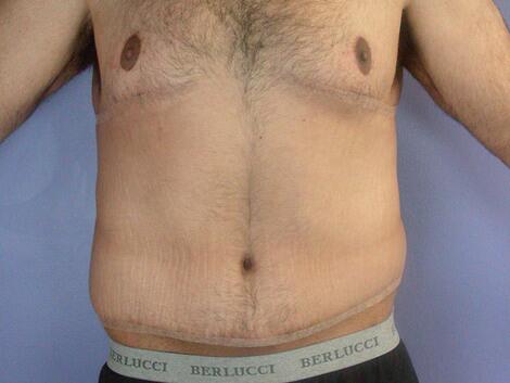 Breast Reduction (for Men) Before & After Image