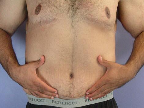 Breast Reduction (for Men) Before & After Image