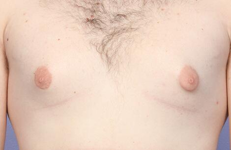 Breast Reduction (for Men) Before & After Image