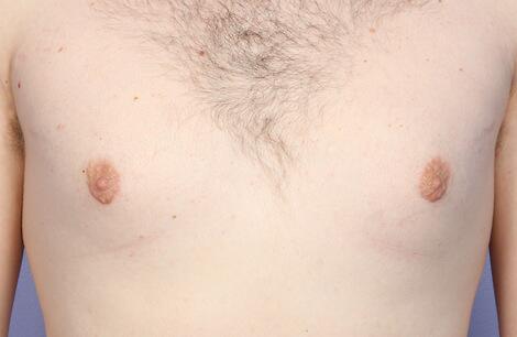 Breast Reduction (for Men) Before & After Image