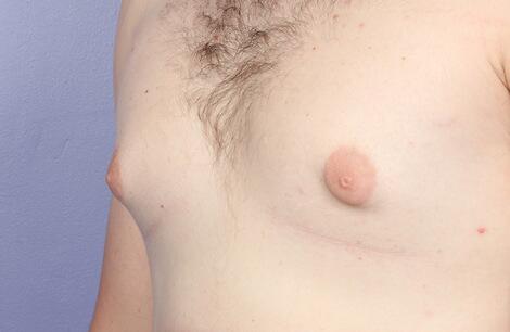 Breast Reduction (for Men) Before & After Image