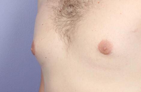 Breast Reduction (for Men) Before & After Image