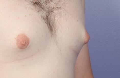 Breast Reduction (for Men) Before & After Image