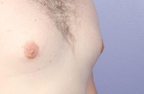 Breast Reduction (for Men) Before & After Image