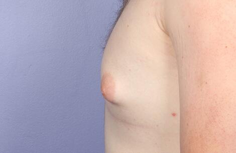 Breast Reduction (for Men) Before & After Image