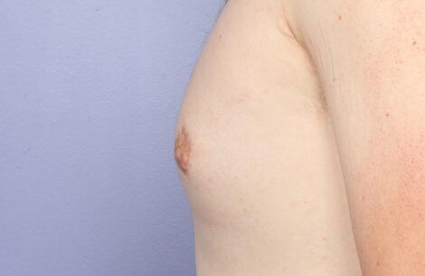 Breast Reduction (for Men) Before & After Image