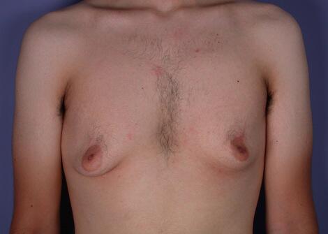 Breast Reduction (for Men) Before & After Image