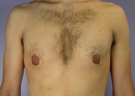 Breast Reduction (for Men) Before & After Image