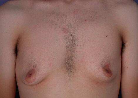 Breast Reduction (for Men) Before & After Image