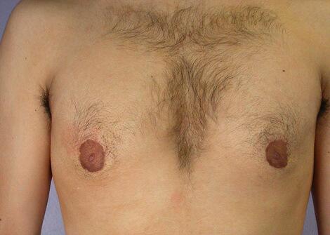 Breast Reduction (for Men) Before & After Image