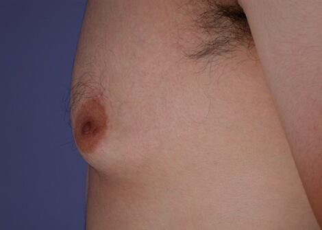 Breast Reduction (for Men) Before & After Image