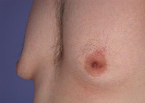 Breast Reduction (for Men) Before & After Image