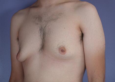 Breast Reduction (for Men) Before & After Image