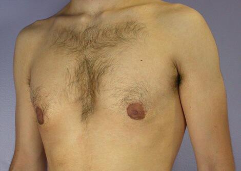 Breast Reduction (for Men) Before & After Image